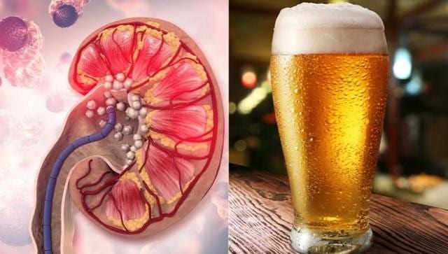 beer_in_kidney_stone_1661697459